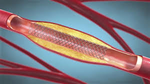 Best Doctor for Carotid Stenting in Vile Parle