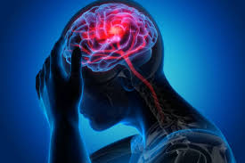 Best Neurologist for Stroke Treatment in Vile Parle