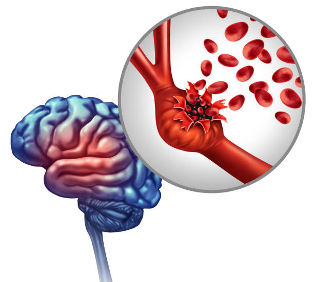 Best Specialist for Brain Aneurysm in Vile Parle